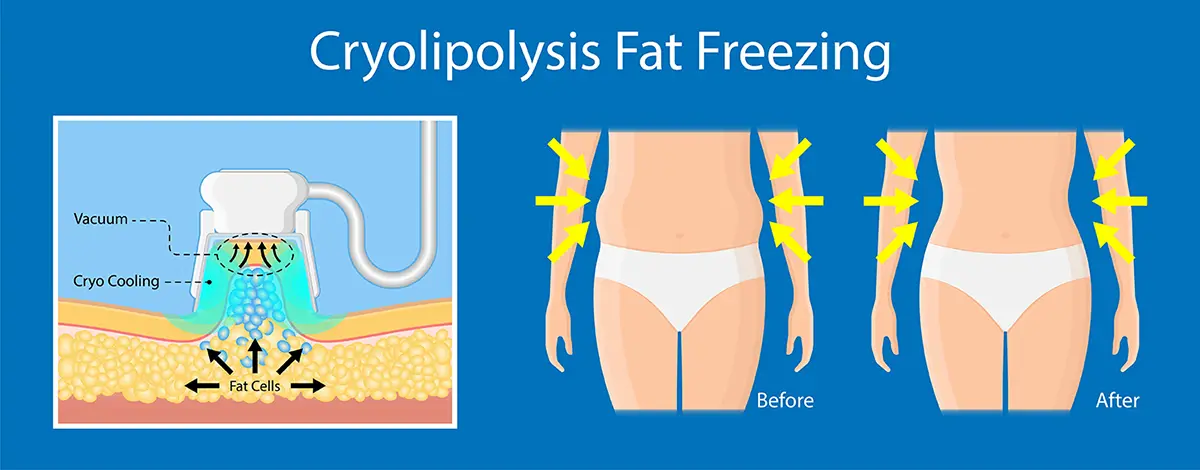 Kryolipolyse Behandlung – Fettzellen gezielt mit Kälte behandeln