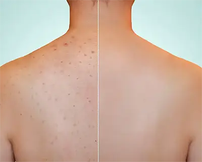 Nahaufnahme des Rückens einer jungen Frau mit rotem Hautausschlag und Aknenarbe in Bezug auf Hautprobleme im Sommer, insbesondere an der Schulter.