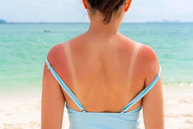 Sonnenverbrannte Haut an Schulter und Rücken einer Frau, weil sie keine Creme mit Sonnenschutz verwendet.