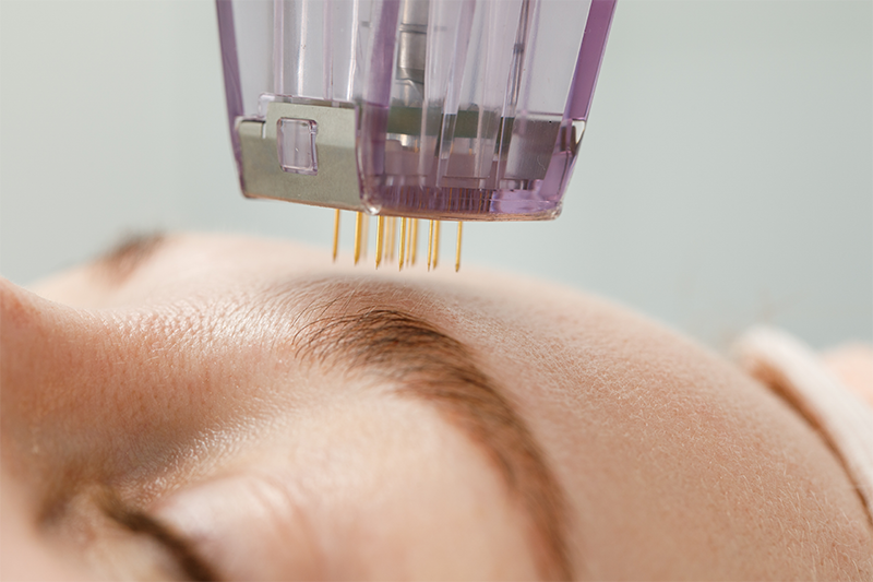 Microneedling ist eine Behandlungsoption für Faltenreduzierung bei einer Frau im Kosmetikstudio im Taunus und Bad Soden